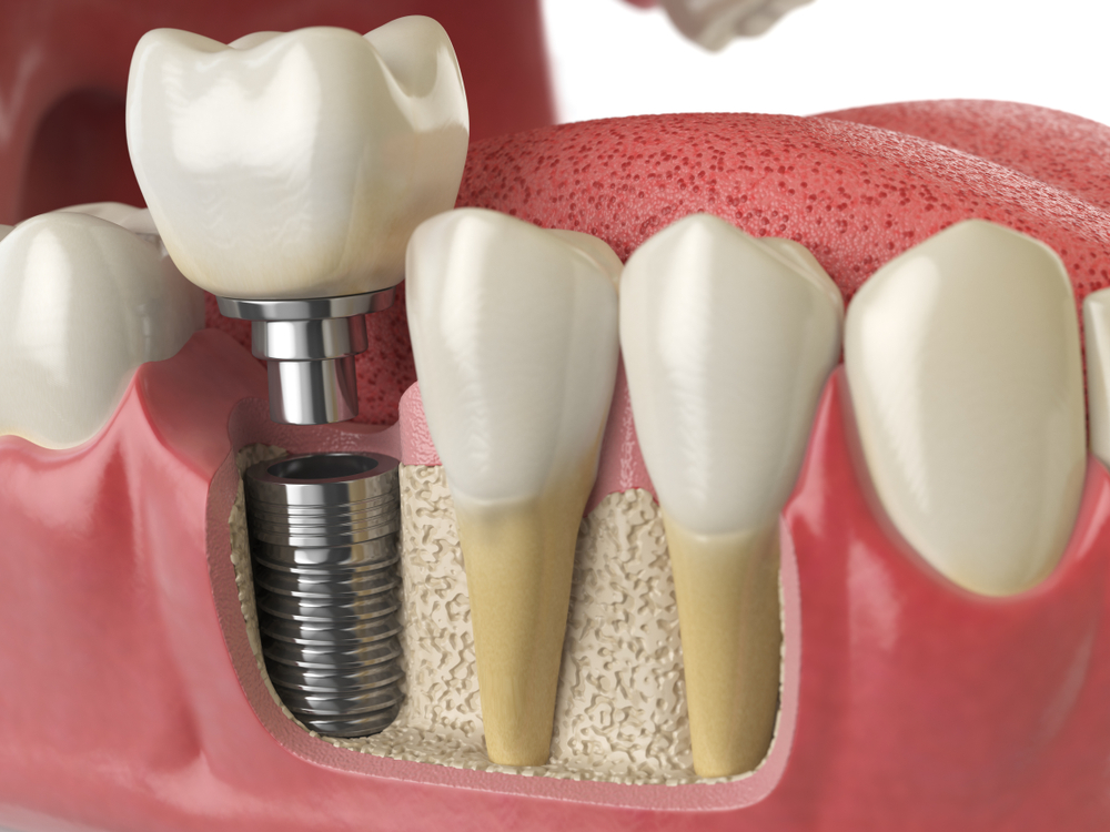 Dental Implants in a dental implant model, showing the implant posts in the gums