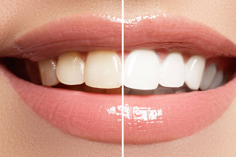 Teeth Whitening Before And After Photo
